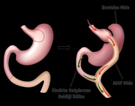 Gastrik Bypass Ameliyatı